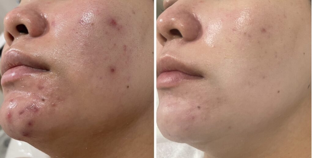 HAKU BEAUTY｜浦添　エステ｜肌質ケア｜フェイシャルケア｜ニキビ｜シミ