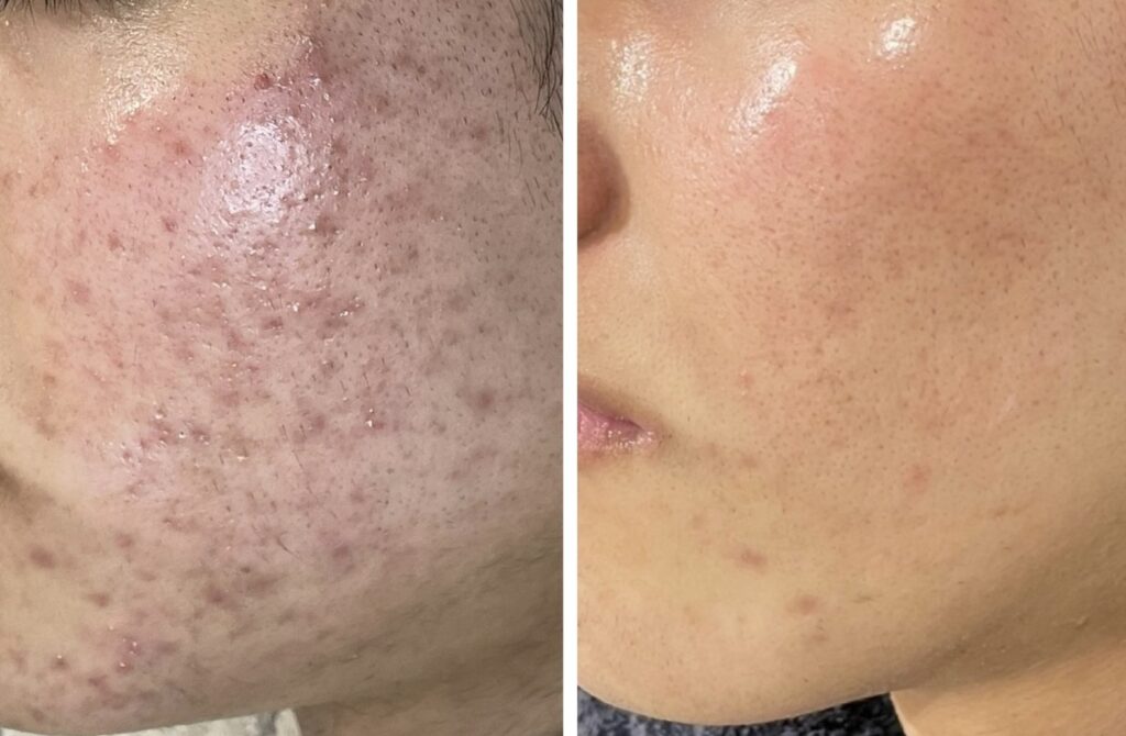 HAKU BEAUTY｜浦添　エステ｜肌質ケア｜フェイシャルケア｜ニキビ｜シミ