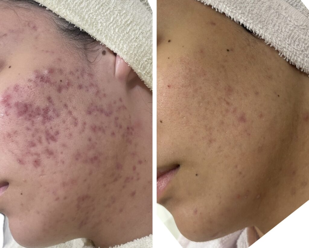 HAKU BEAUTY｜浦添　エステ｜肌質ケア｜フェイシャルケア｜ニキビ｜シミ