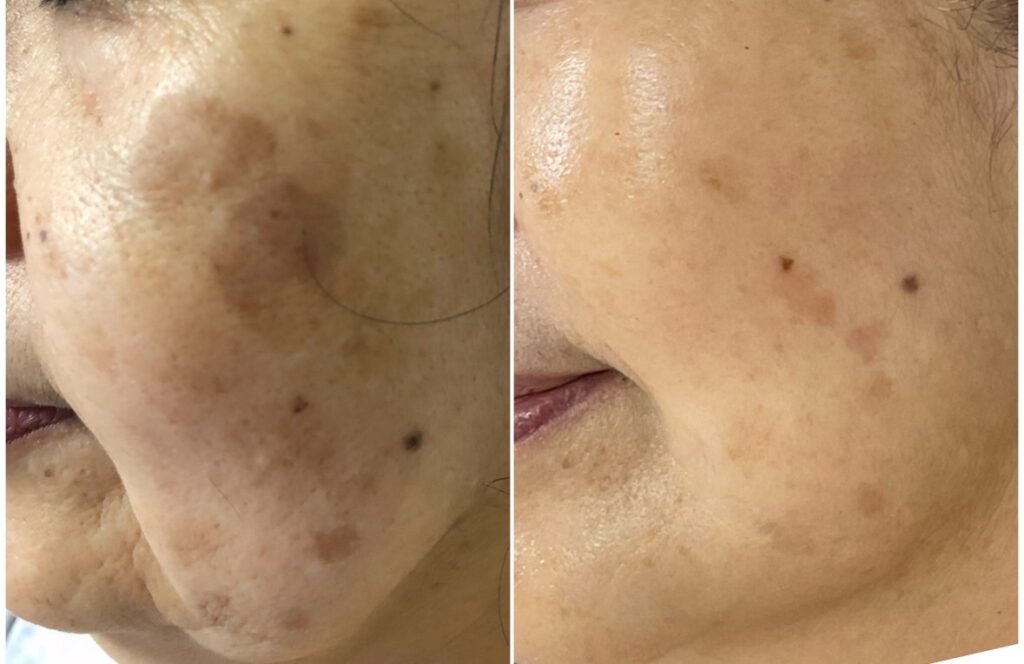 HAKU BEAUTY｜浦添　エステ｜肌質ケア｜フェイシャルケア｜ニキビ｜シミ