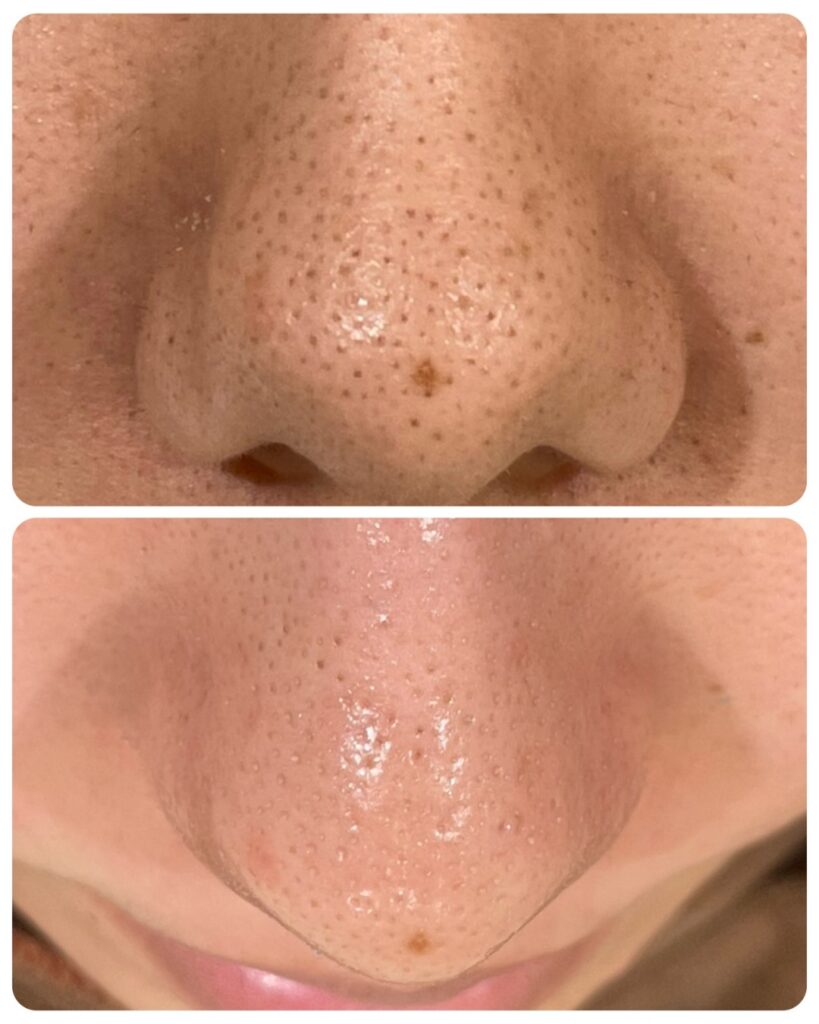 HAKU BEAUTY｜浦添　エステ｜肌質ケア｜フェイシャルケア｜ニキビ｜シミ|毛穴ケア