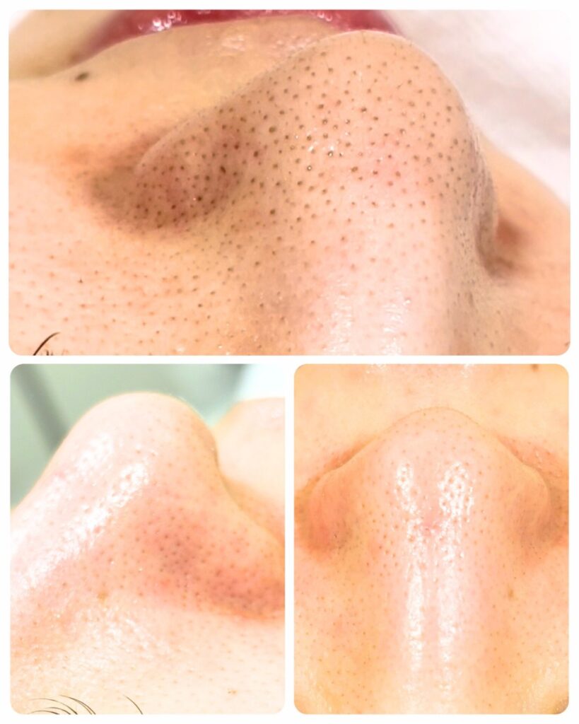 HAKU BEAUTY｜浦添　エステ｜肌質ケア｜フェイシャルケア｜ニキビ｜シミ|毛穴ケア