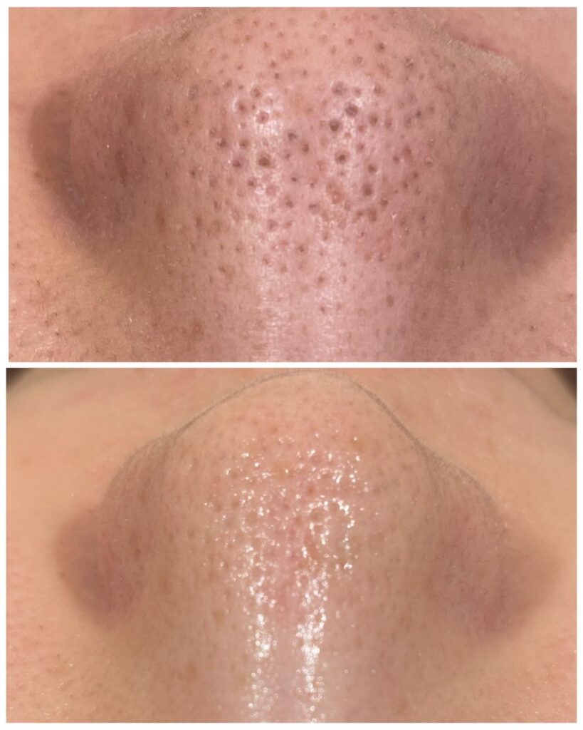 HAKU BEAUTY｜浦添　エステ｜肌質ケア｜フェイシャルケア｜ニキビ｜シミ|毛穴ケア