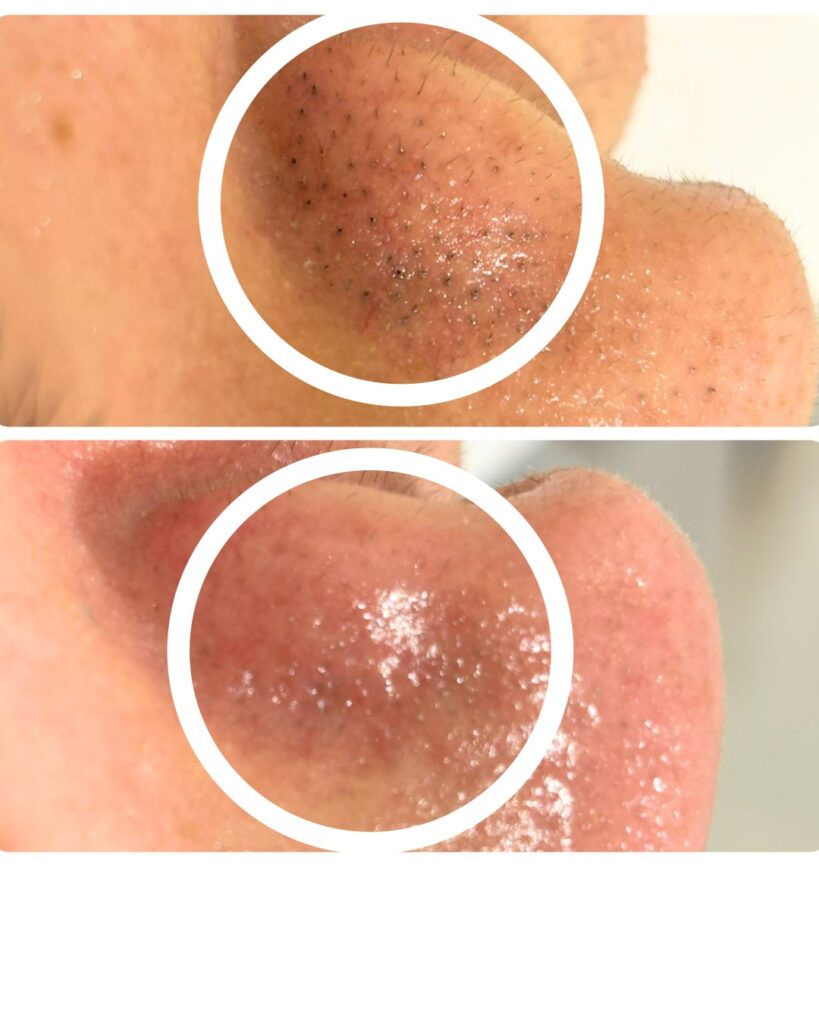 HAKU BEAUTY｜浦添　エステ｜肌質ケア｜フェイシャルケア｜ニキビ｜シミ|毛穴ケア