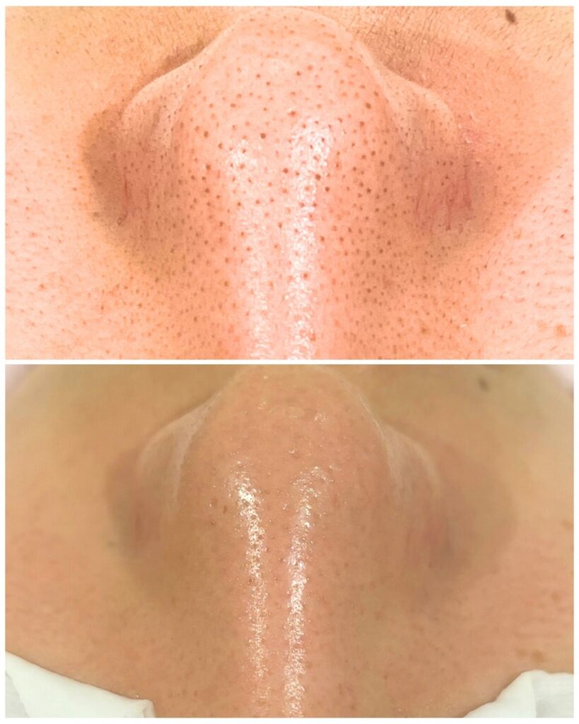 HAKU BEAUTY｜浦添　エステ｜肌質ケア｜フェイシャルケア｜ニキビ｜シミ|毛穴ケア