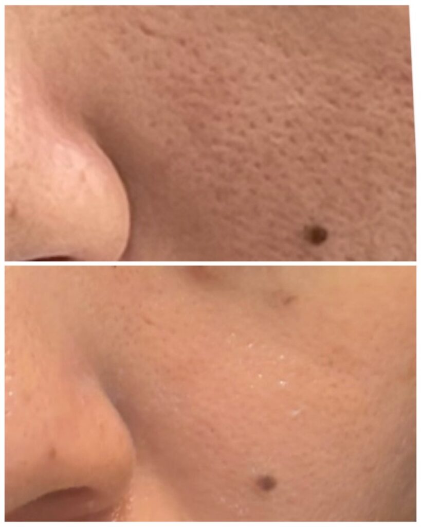 HAKU BEAUTY｜浦添　エステ｜肌質ケア｜フェイシャルケア｜ニキビ｜シミ|毛穴ケア